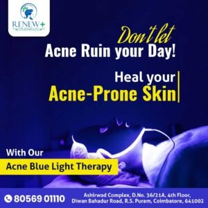 Acne Blue Light Therapy.jpeg